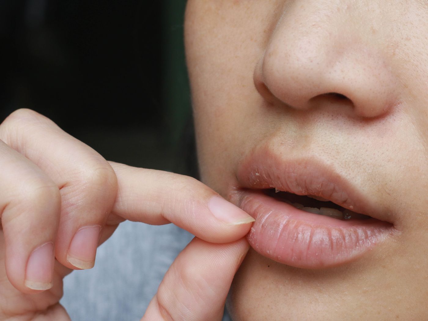 Effective Home Remedies for Dry, Chapped and Cracked Lips