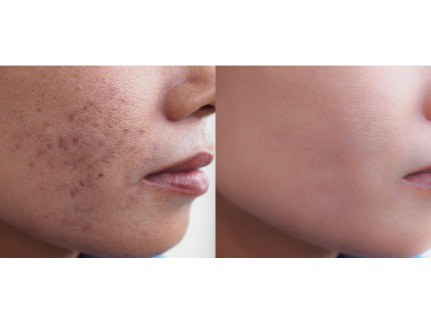 large pores before and after