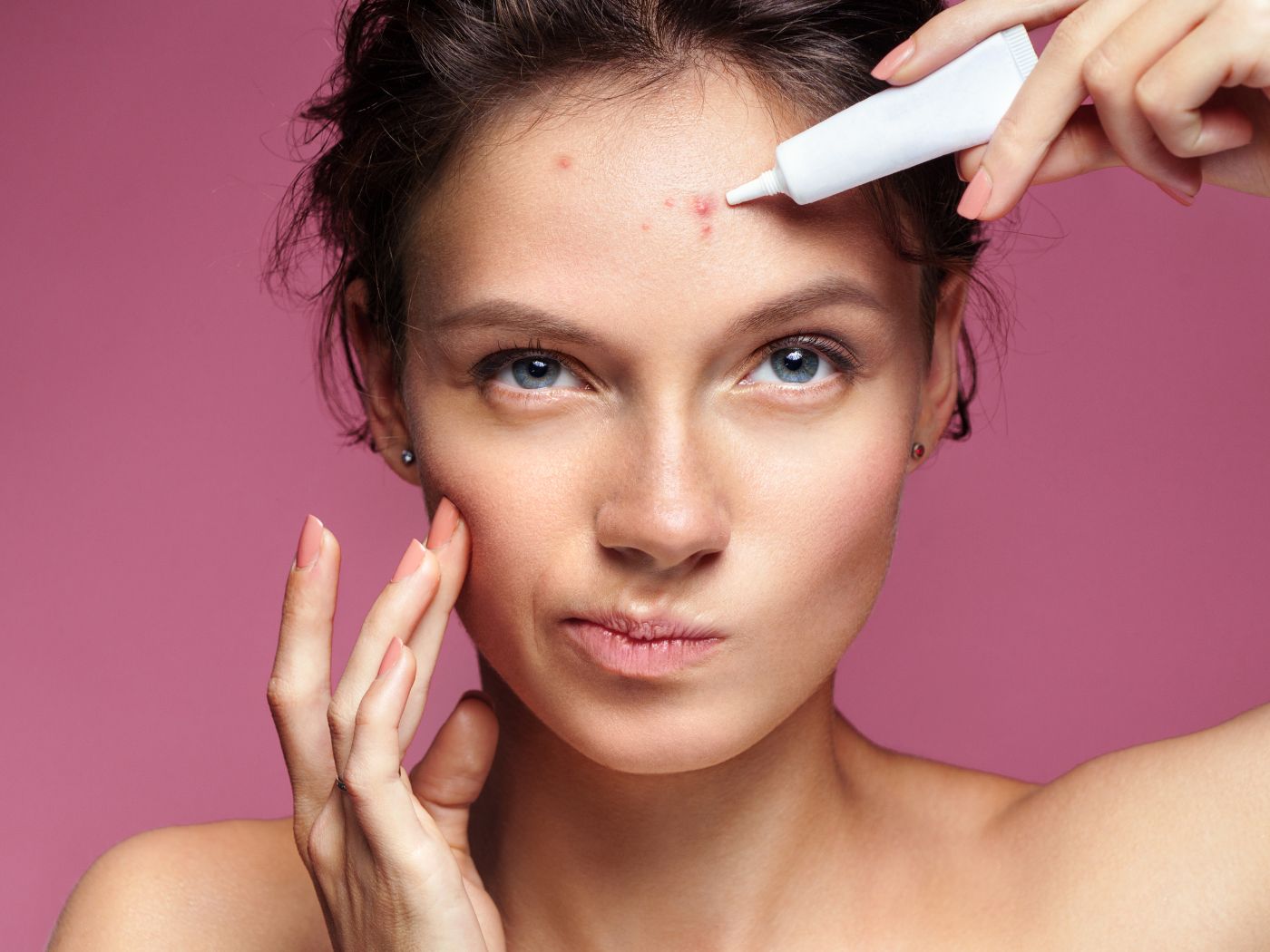 Sweat Pimples On The Forehead - Causes & Prevention