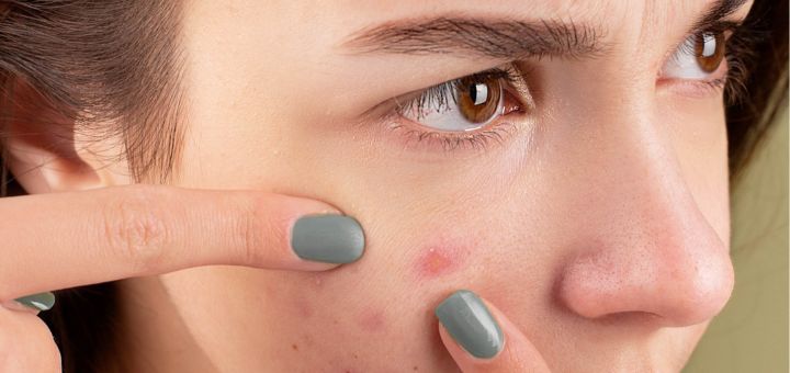 Want pimple-free skin? Here’s the cheat sheet!