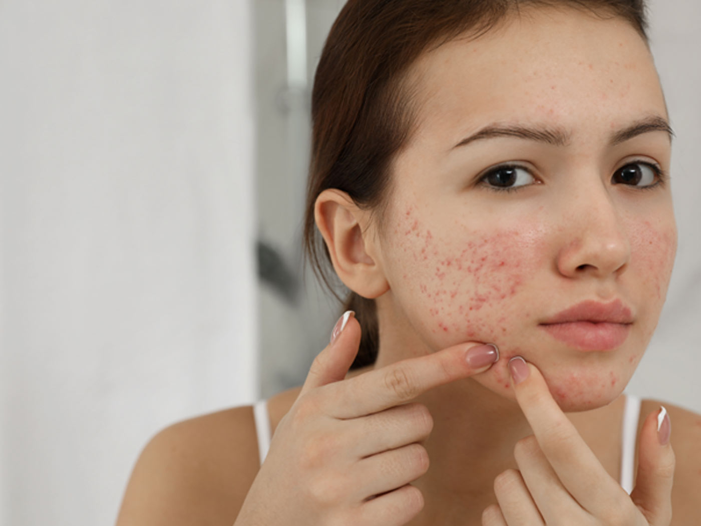 How to get rid of acne due to dandruff